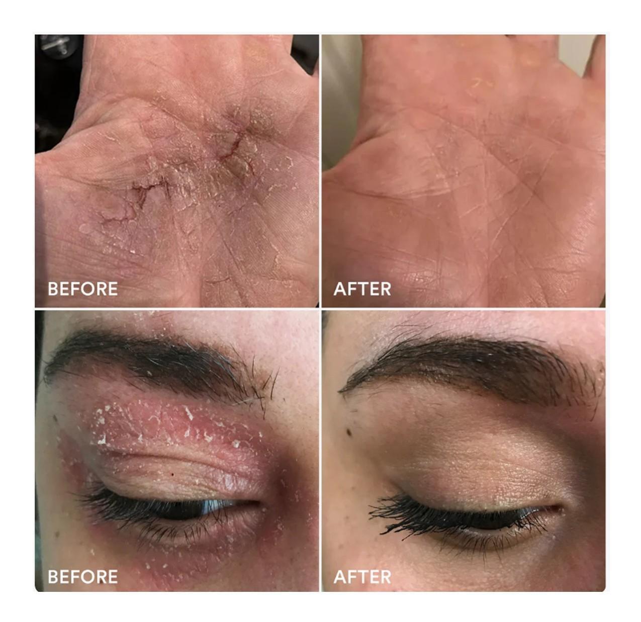 A split image shows two sets of before-and-after photos: the top row features dry, cracked hands before and smoother skin after using Marin Soothing Hydration Cream; the bottom row shows a flaky eyelid before and clear, healthy skin after.